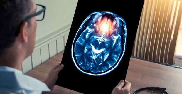 Stroke: A gyors felismerés nyáron is életmentő
