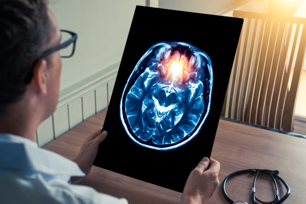 Stroke: A gyors felismerés nyáron is életmentő