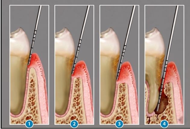 Így válthatja ki az EMS professzionális fogtisztítás a dentálhigiéniai kezelések kellemetlenségeit Így válthatja ki az EMS professzionális fogtisztítás a dentálhigiéniai kezelések kellemetlenségeit