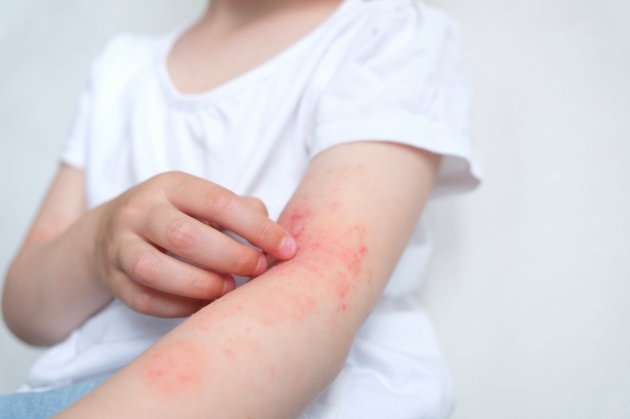 Nőt az atópiás dermatitisszes gyermekek száma Nőt az atópiás dermatitisszes gyermekek száma