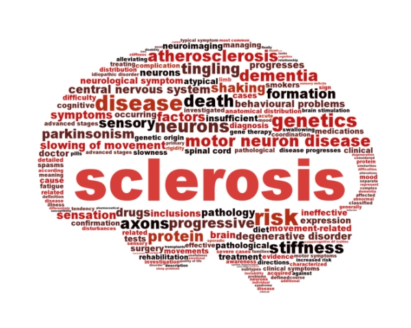 A sclerosis multiplex