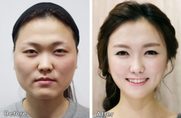 A koreai plasztikai sebészet csodája – Képek előtte, utána