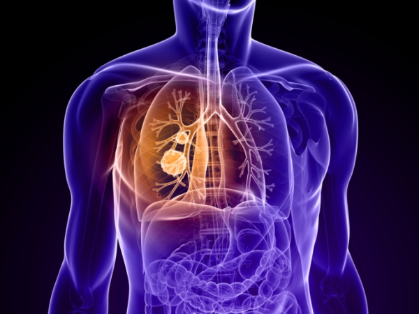 Tüdőrák: okok és tünetek - EgészségKalauz